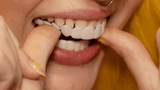 Snap-On Smile Veneers – Herbruikbare Tanden Facings voor een Stralende Glimlach zonder Tandarts