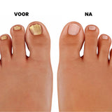 PureNail - Gepatenteerde nagelschimmeltherapie – voor gezonde nagels binnen 4 weken