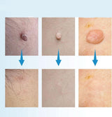 DERMASWIFT – Huidvlekkenverwijderaar tegen Wratten & Huidtags