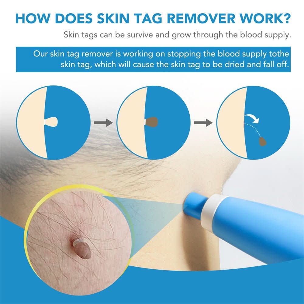 DERMASWIFT – Huidvlekkenverwijderaar tegen Wratten & Huidtags