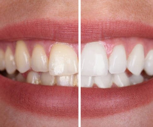 PerfectSmile | Genieten van een stralend witte lach, zonder risico's!
