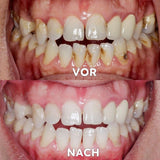 Mineralenpoeder voor Mondverzorging | Versterkt & Beschermt Tanden | SmileSchutz