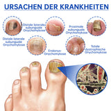 NailCure - Schimmelbehandeling voor Nagels met Laser (50% KORTING)