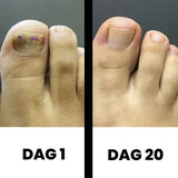 DermaNail - Gepatenteerde nagelschimmeltherapie – voor gezonde nagels binnen 4 weken