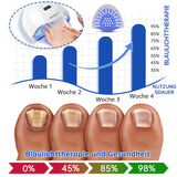 NailCure - Schimmelbehandeling voor Nagels met Laser (50% KORTING)