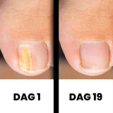 DermaNail - Gepatenteerde nagelschimmeltherapie – voor gezonde nagels binnen 4 weken
