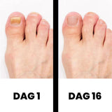 DermaNail - Gepatenteerde nagelschimmeltherapie – voor gezonde nagels binnen 4 weken