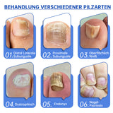NailCure - Schimmelbehandeling voor Nagels met Laser (50% KORTING)