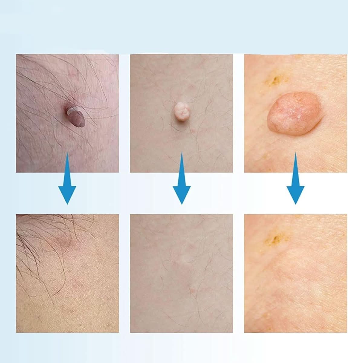 DERMASWIFT – Huidvlekkenverwijderaar tegen Wratten & Huidtags