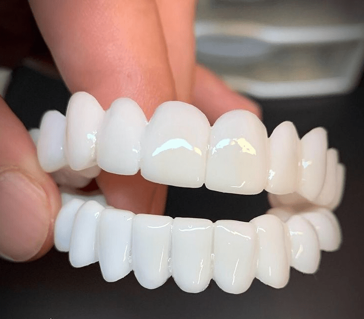 SmileFlex – Aanpasbare Tandprothese met Tandheelkundige Lensen