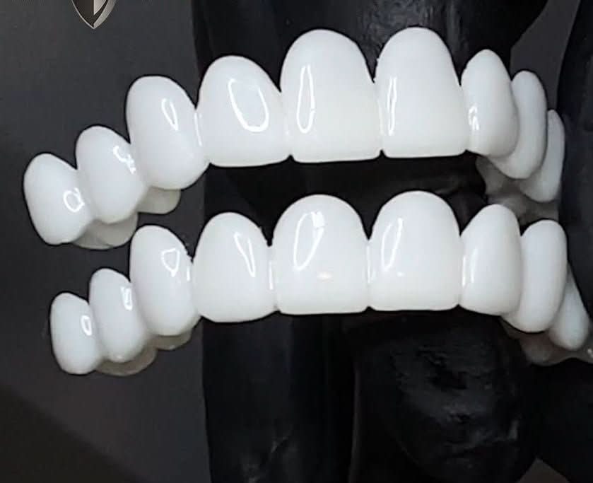 SmileFlex – Aanpasbare Tandprothese met Tandheelkundige Lensen