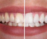 PerfectSmile | Genieten van een stralend witte lach, zonder risico's!
