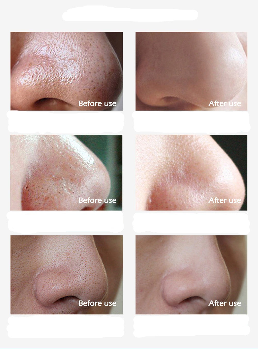 ClearSkin | Zwarte Punt Verwijderaar
