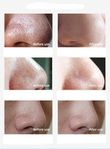ClearSkin | Zwarte Punt Verwijderaar